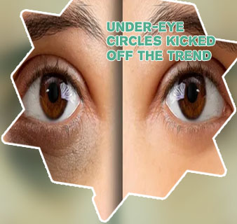 Dark circle under eye trend