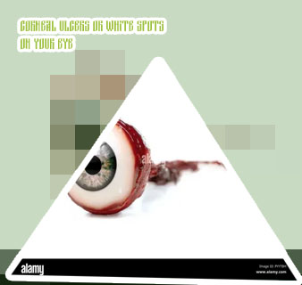 White patch on eyeball